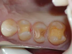 奥歯 セラミック治療before