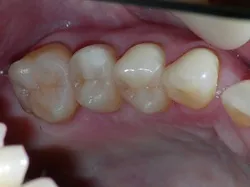 奥歯 セラミック治療after