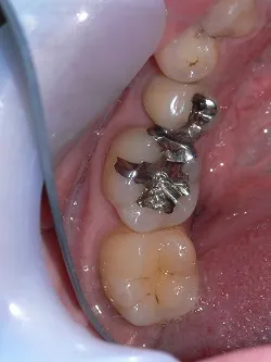 銀歯を入れてから3年後の写真before