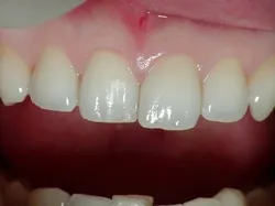 前歯ラミネートベニア セラミック治療before