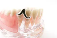 部分床義歯(部分入れ歯)